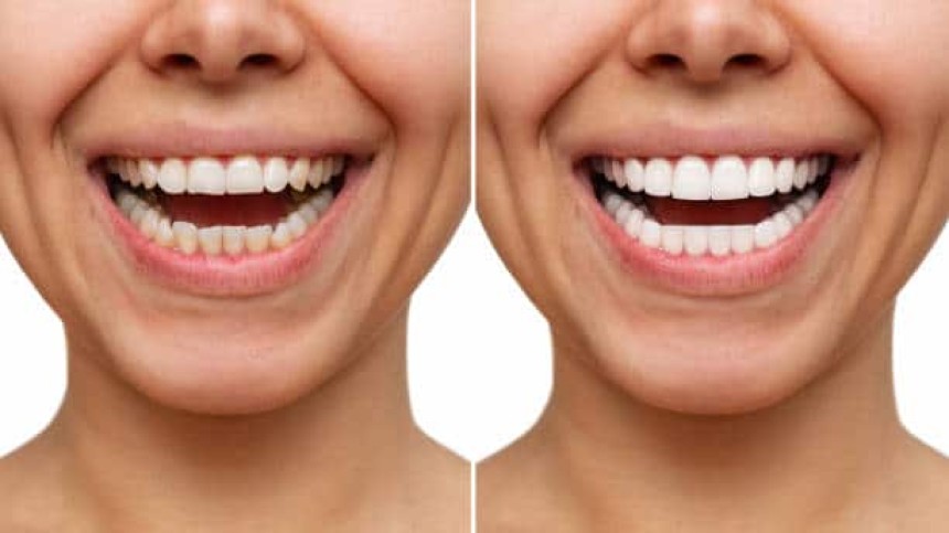 Blogs - Bang Box online - Porcelain vs. Composite Veneers: Which One Is Right for You?