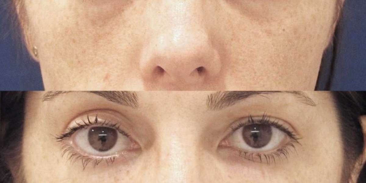 How Tear Trough Filler Restoring Your Under-Eyes