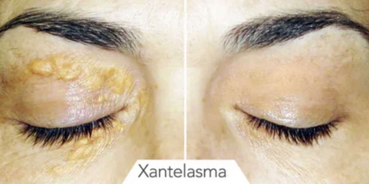 Xanthelasma Removal Expert Treatment Options in London